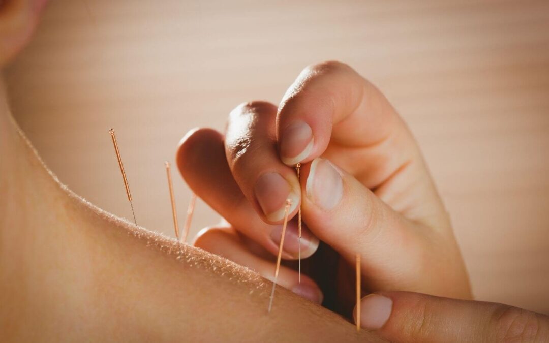 akupunktura