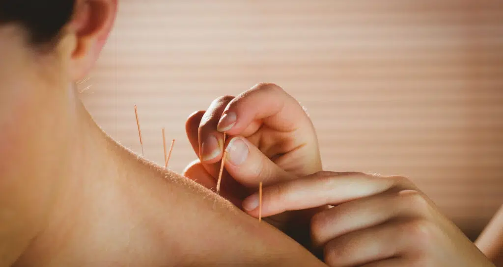 igłoterapia